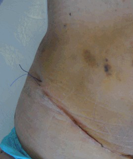 Resultado insatisfatório de Abdominoplastia