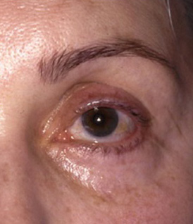 Resultado insatisfatório de Blefaroplastia (olhos)