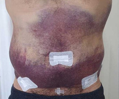 Resultado insatisfatório de Lipoaspiração / Lipo HD